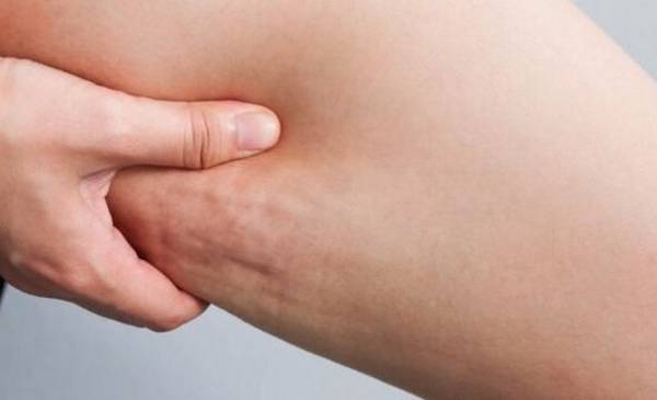 Cellulite: the most common condition in female skin and how to treat it effectively
